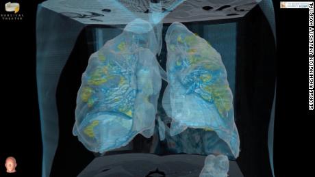 Silent hypoxia: Covid-19 patients who should be gasping for air but aren&#39;t
