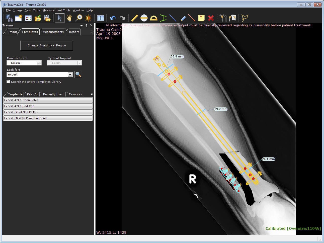 Preoperative planning software - TraumaCad® TRAUMA - Voyant HEALTH -  Brainlab - analysis / measurement / orthopedic surgery