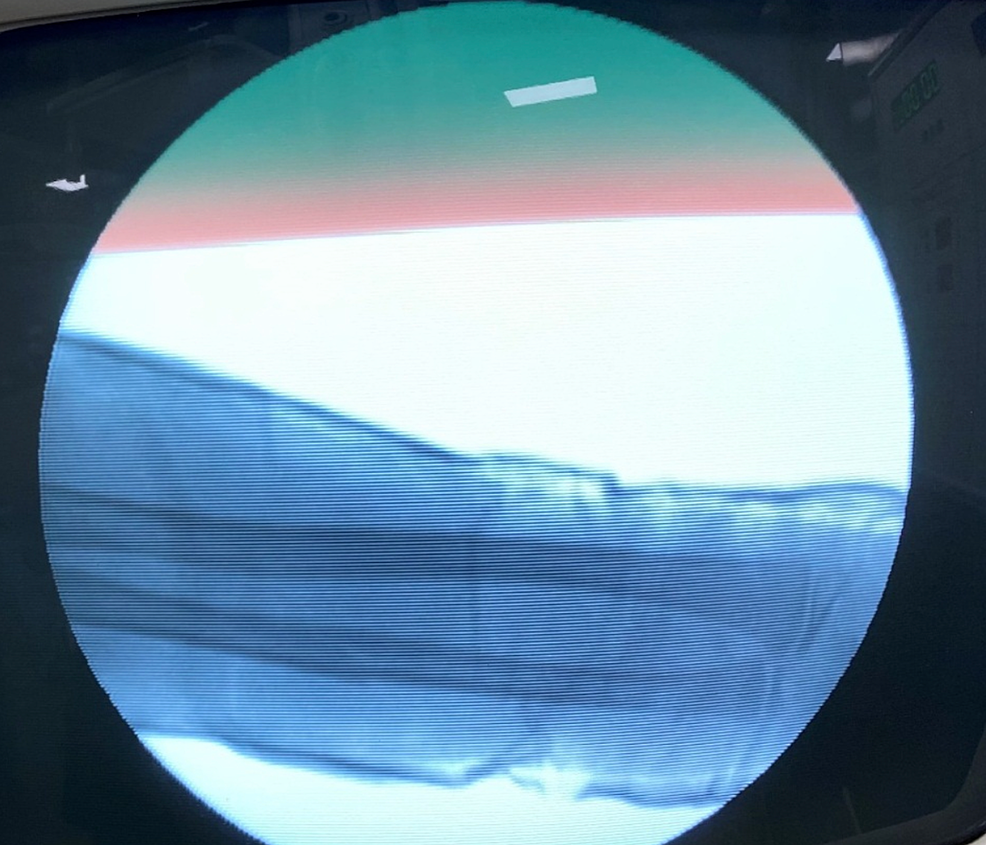 Intra-operative-"c-arm"-picture-antero-posterior-view-after-performing-reduction