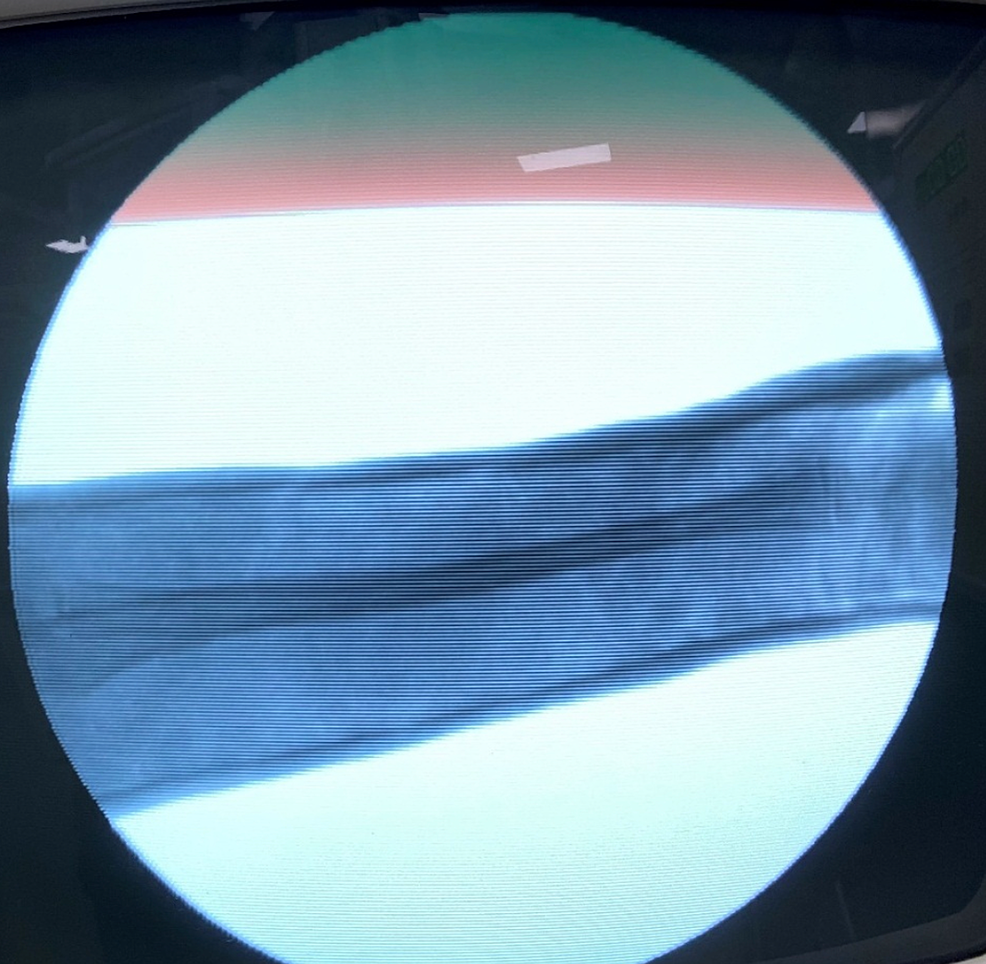 Intra-operative-"c-arm"-picture-lateral-view-after-performing-reduction