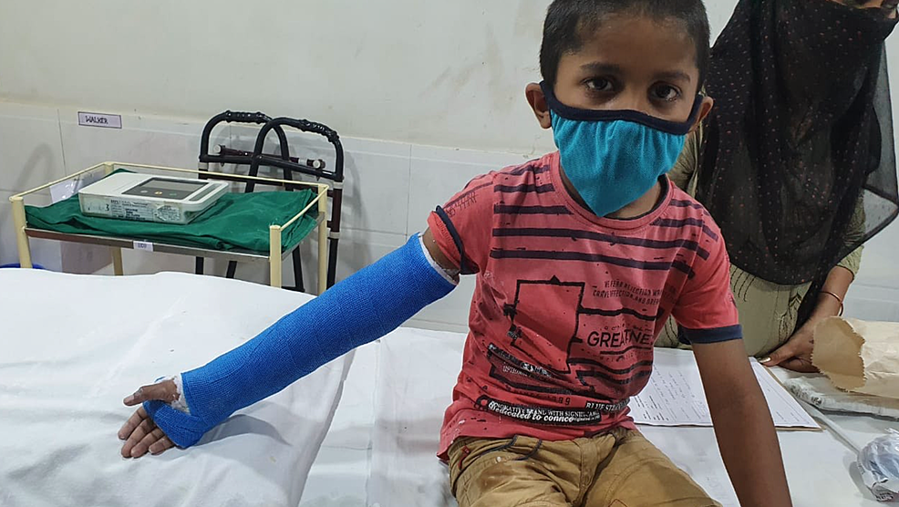 Clinical-picture-of-a-child-with-casting-done-in-extended-position