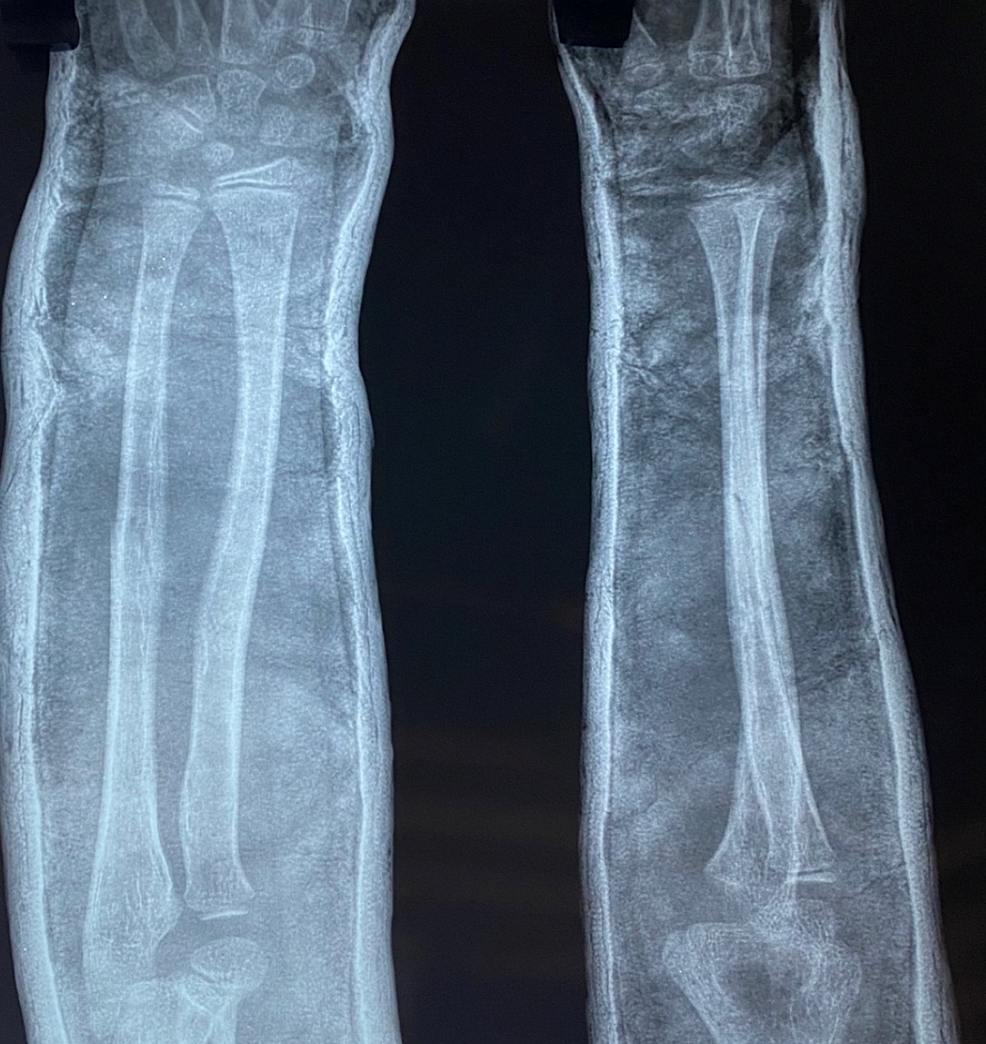 Post-operative-radiograph-taken-two-weeks-after-casting