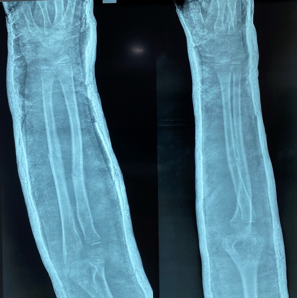 Post-operative-radiograph-taken-four-weeks-after-casting