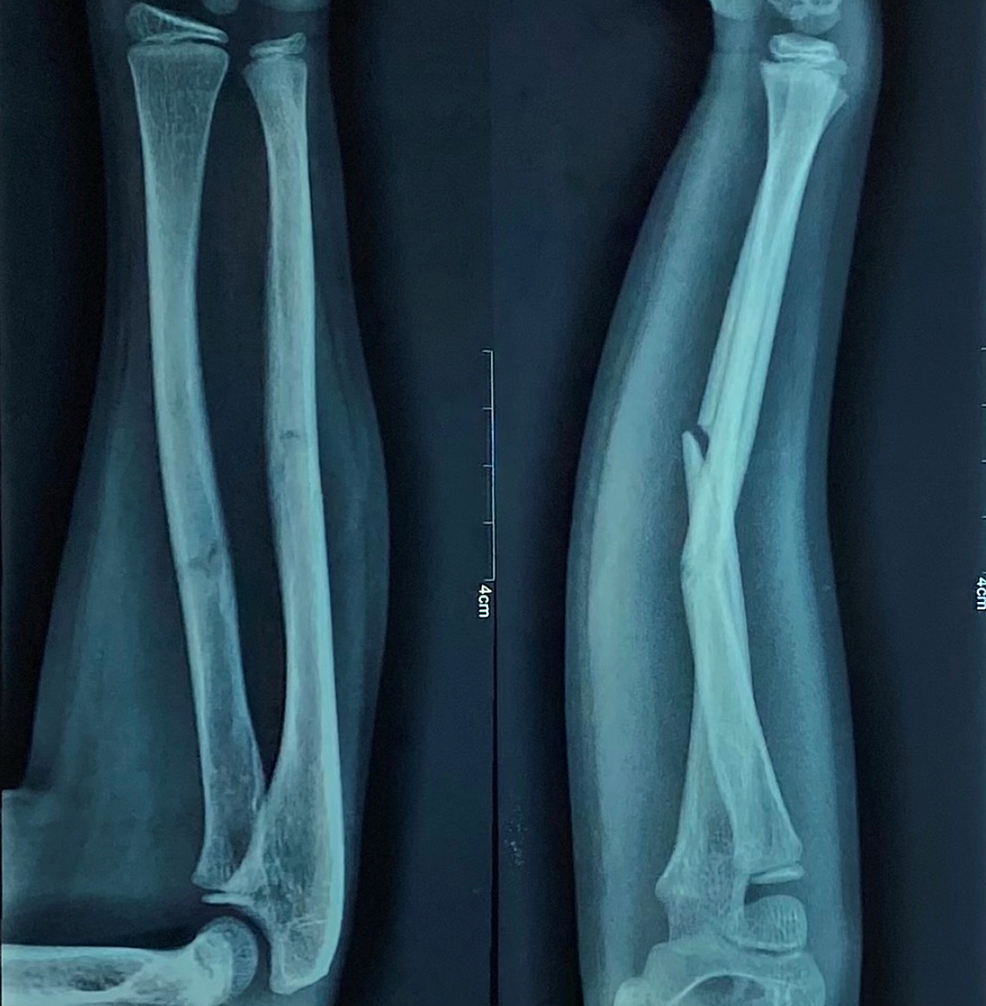Pre-operative-radiograph-of-a-case-of-radius-and-ulna-shaft-fracture