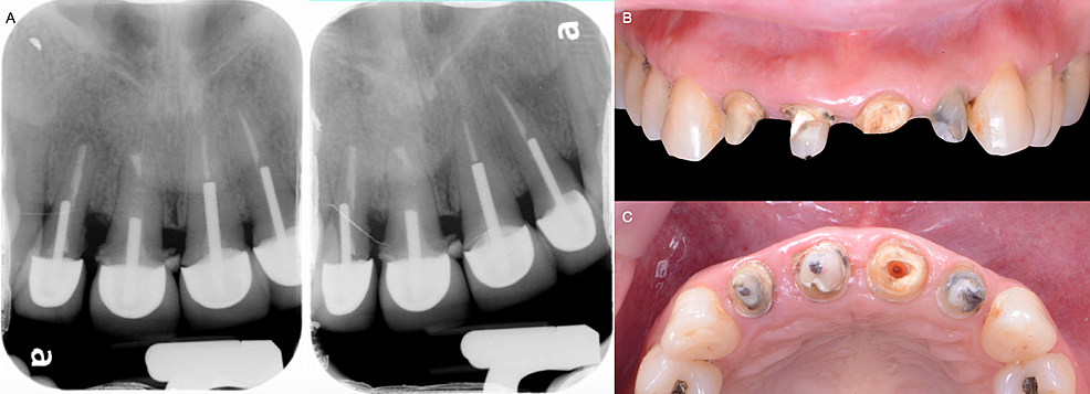 A)-Initial-radiographs-and-B)-Clinical-evaluation-after-crown-removal.