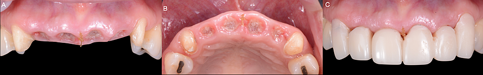 A)-Tooth-extractions,-B)-Suturing,-and-C)-Provisional-restoration.