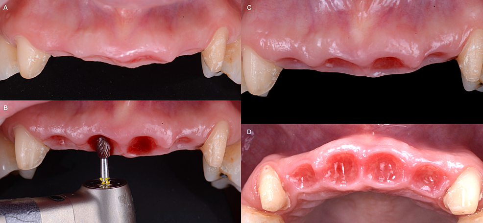 After-two-months-of-teeth-extractions:-A)-Initial-contour,-B)-Contouring-soft-tissue,-C)-Contoured-tissue-frontal-view,-and-D)-Contoured-tissue-occlusal-view.