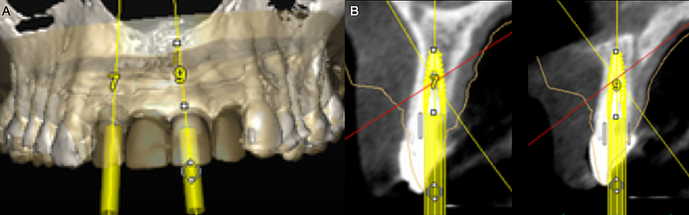 A)-Frontal-view-of-the-digital-implant-planning.-B)-Interproximal-view-of-the-implant-planning.