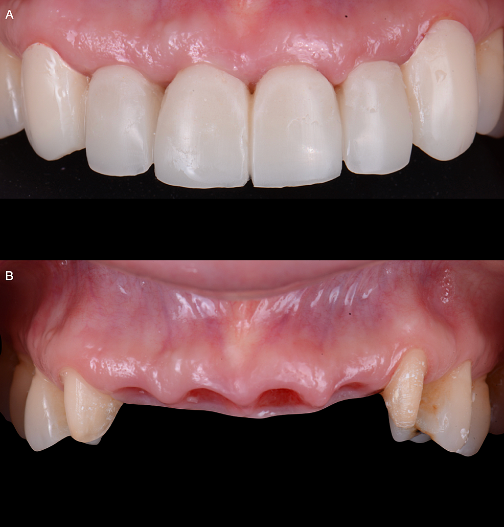 A)-Screw-retained-provisional-restoration-frontal-view,-and-B)-Final-tissue-soft-tissue-architecture.