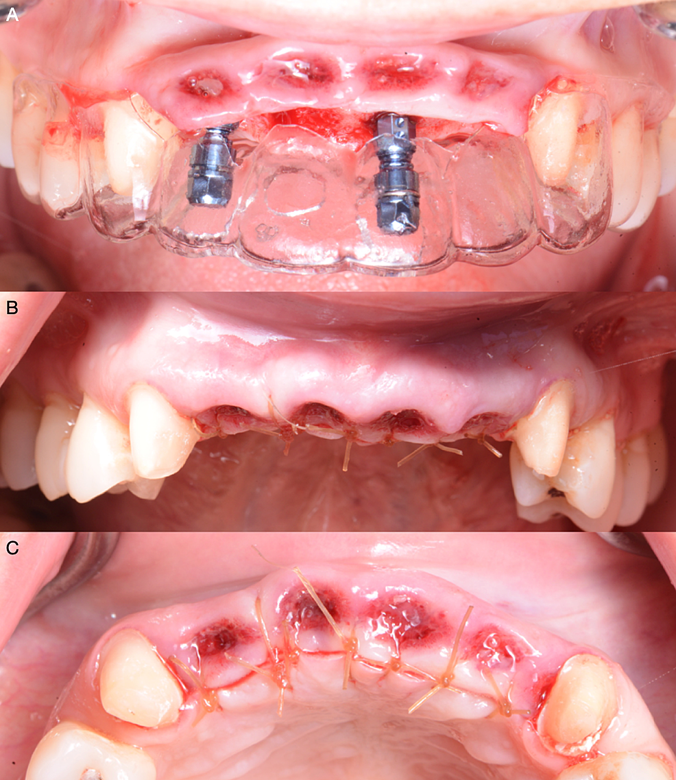 A)-Implant-placement,-B)-Suturing-frontal-view,-and-C)-Suturing-occlusal-view.