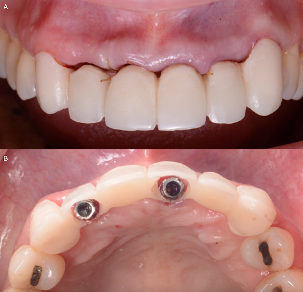A)-Screw-retained-implant-provisional-restoration-frontal-view,-and-B)-Screw-retained-provisional-restoration-occlusal-view.