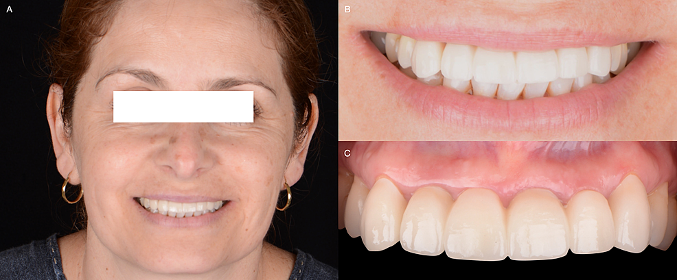 A)-Final-face-smiling,-B)-Final-smile,-and-C)-Final-intra-oral.