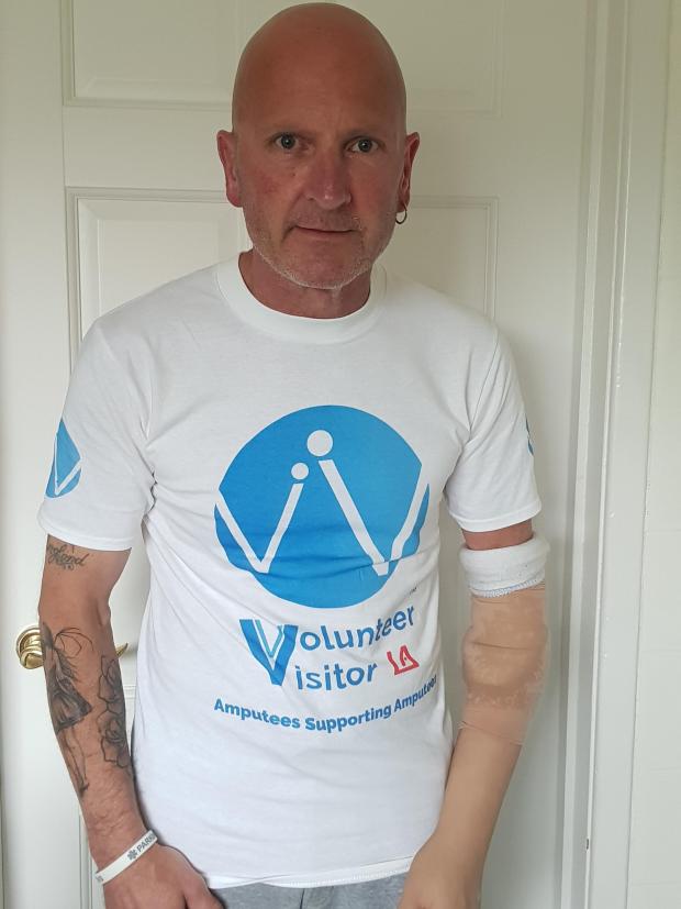 Darlington and Stockton Times: Crispin Cole, from Northallerton, suffered such severe injuries in a factory incident in 1989 that surgeons could not reattach his hand