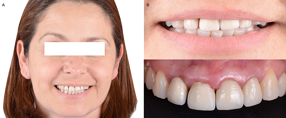 A)-Initial-face-smiling,-B)-Initial-smile,-and-C)-Initial-intra-oral-situation.