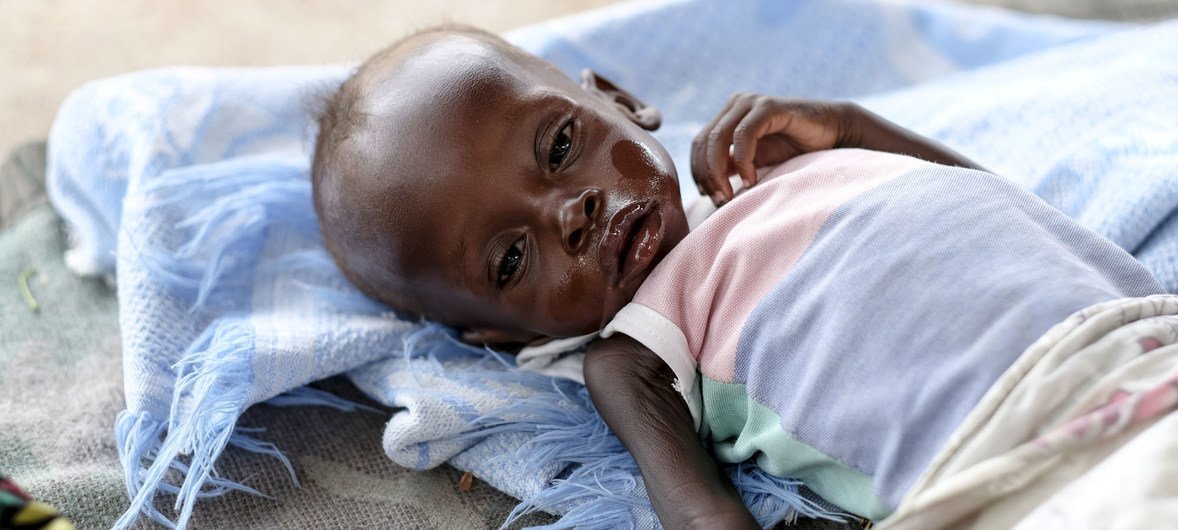 Eight month-old boy is being treated for severe malnutrition in Al Sabbah Children’s Hospital in Juba, South Sudan. (2018) Eight month-old boy is being treated for severe malnutrition in Al Sabbah Children’s Hospital in Juba, South Sudan. (2018)
