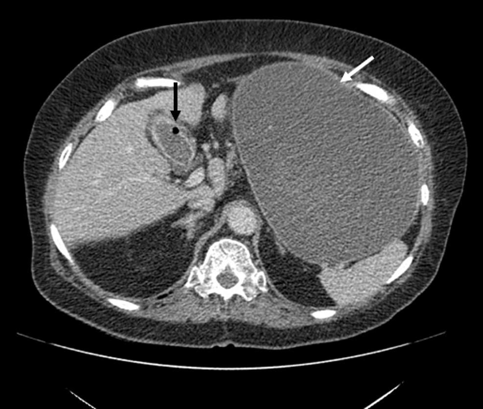 Axial-portal-venous-CT-shows-speck-of-gas-in-the-gallbladder-in-keeping-with-a-fistula-(black-arrow).-Massive-gastric-distension-again-noted-(white-arrow).