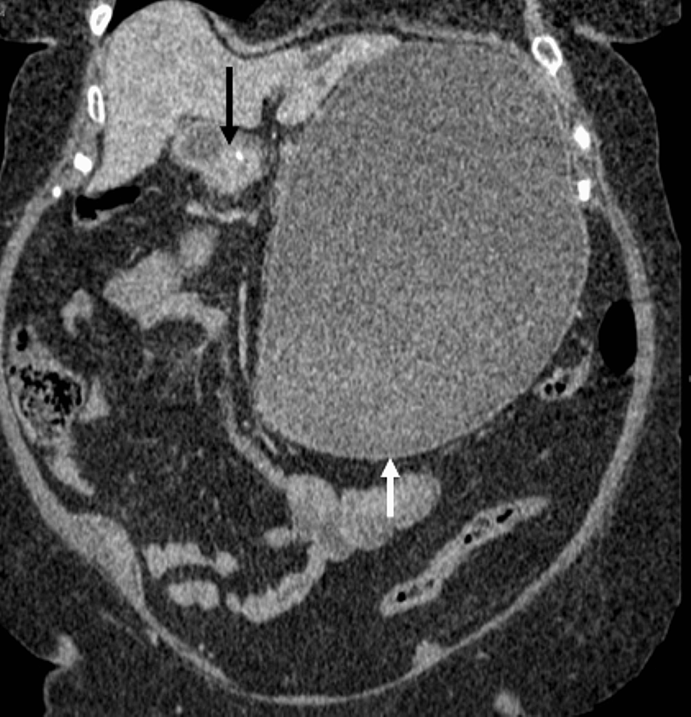 Coronal-portal-venous-CT,-as-previous-image,-showing-gallbladder-adherent-to-duodenum-with-a-calcified-opacity-representing-a-gallstone-within-the-duodenal-lumen-(black-arrow).-Also-note-massive-gastric-distension-(white-arrow).