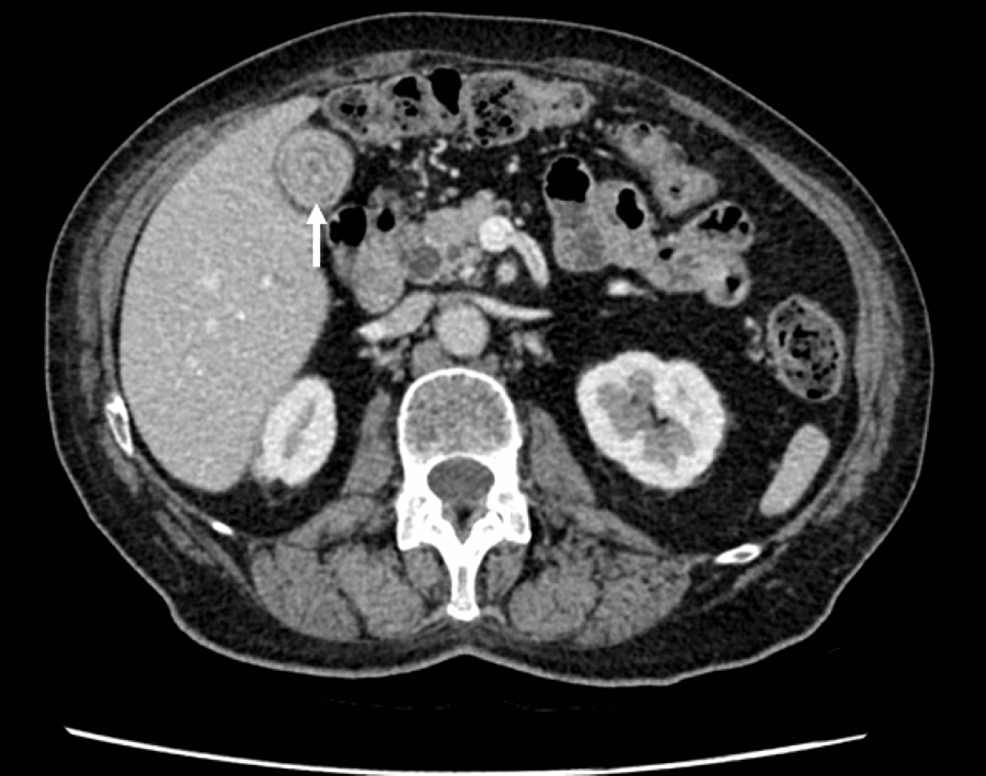 Axial-portal-venous-CT-shows-a-gallstone-within-the-gallbladder-(white-arrow)-with-no-acute-changes.