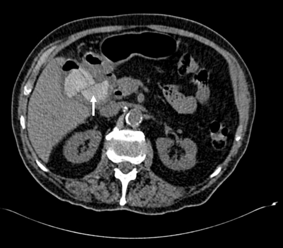 Axial-CT-non-contrast-gallstone-within-the-lumen-of-the-duodenum-(white-arrow).