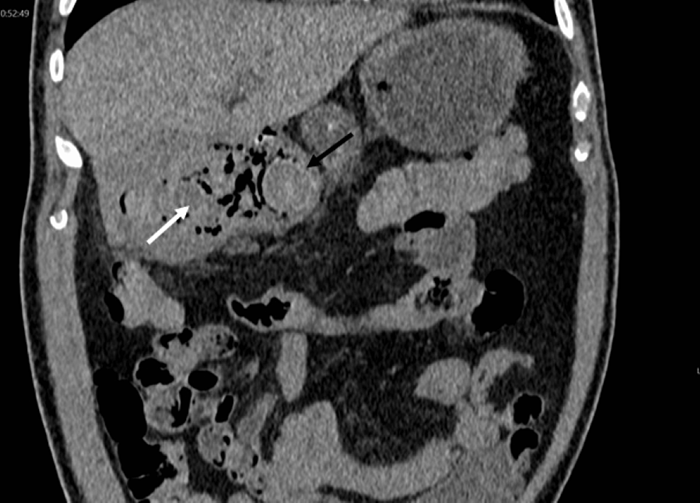 Coronal-CT-non-contrast,-as-previous-image,-demonstrates-gallstone-(black-arrow)-fistulated-into-duodenum-with-gas-in-the-gall-bladder-(white-arrow).