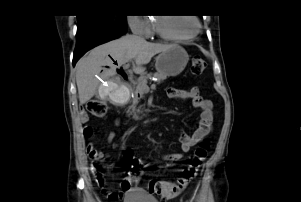 Coronal-CT-showing-gallstone-within-the-lumen-of-the-duodenum-(white-arrow)-and-also-note-gas-within-the-common-bile-duct-(black-arrow).