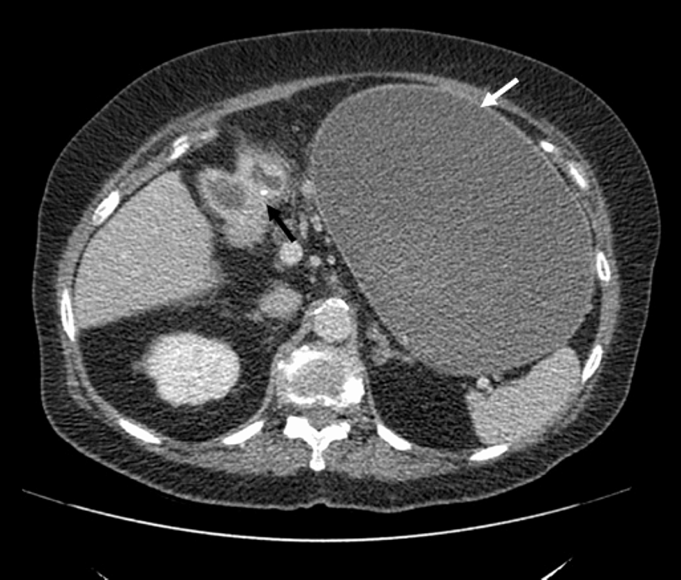 Axial-portal-venous-CT-shows-gallbladder-adherent-to-duodenum-with-a-calcified-opacity-representing-a-gallstone-within-the-duodenal-lumen-(black-arrow)-and-massive-gastric-distension-(white-arrow).
