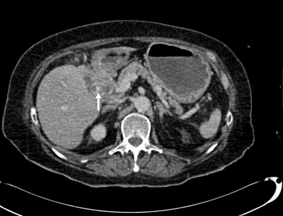Axial-portal-venous-CT-shows-gallstone-fistulated-into-the-duodenum-(white-arrow)-with-gastric-dilatation.