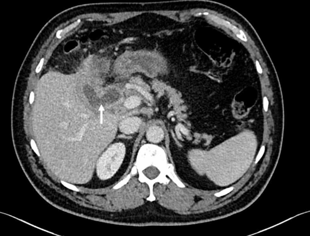 Axial-portal-venous-CT-demonstrates-a-fistula-between-gallbladder-and-duodenum-(white-arrow).