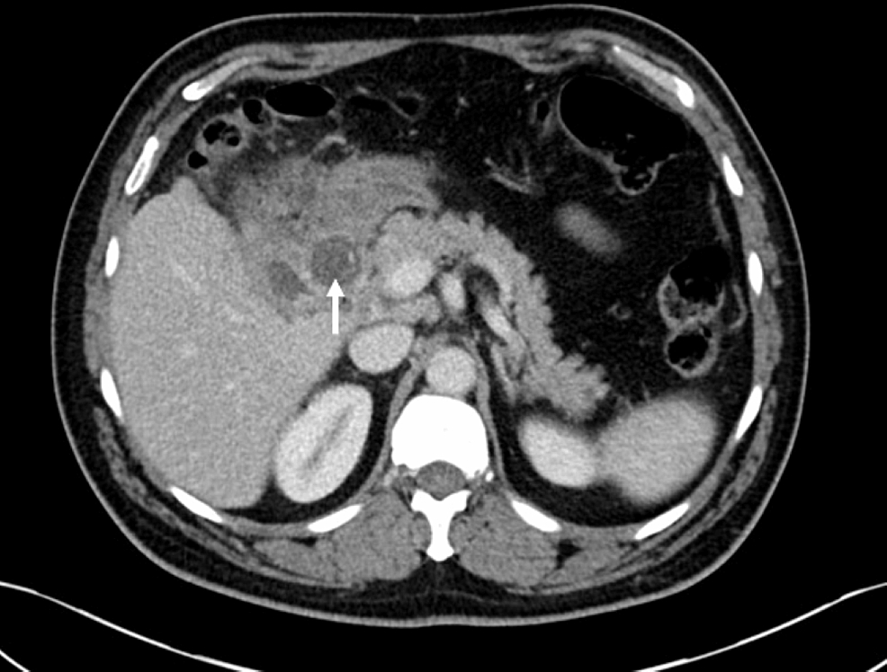 Axial-portal-venous-CT-shows-a-faintly-calcified-gallstone-within-the-fistula-(white-arrow).