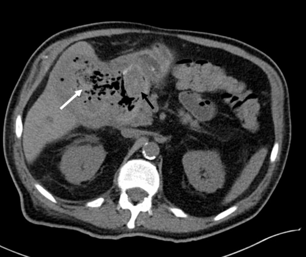 Axial-CT-non-contrast-demonstrates-gallstone-(black-arrow)-fistulated-into-duodenum-with-gas-in-the-gallbladder-(white-arrow).