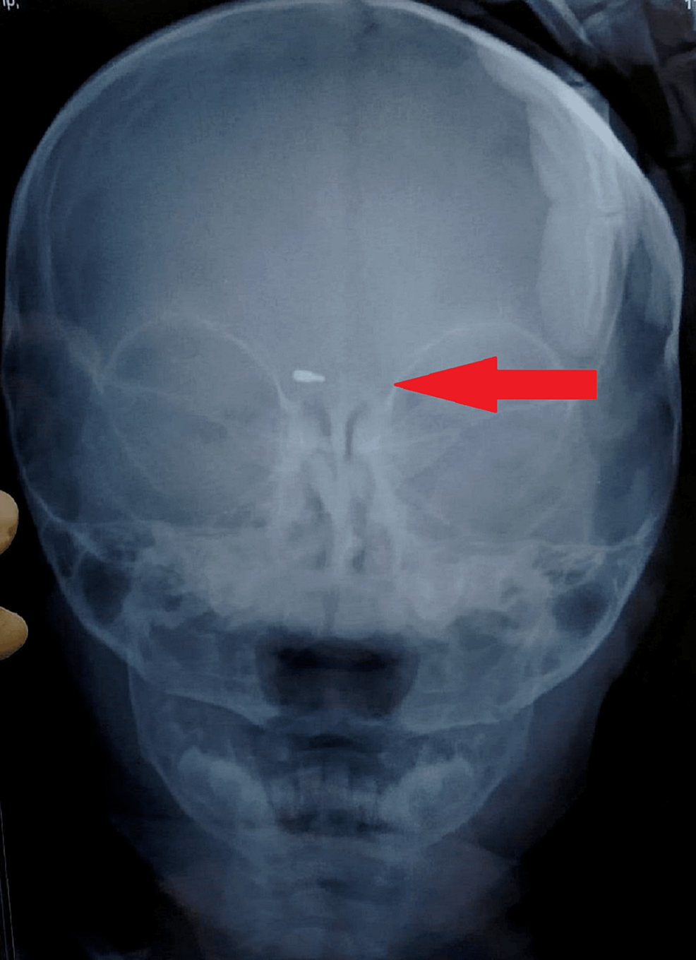 Showing-Radiopaque-Foreign-Material-in-Right-Periorbital-Soft-Tissue.