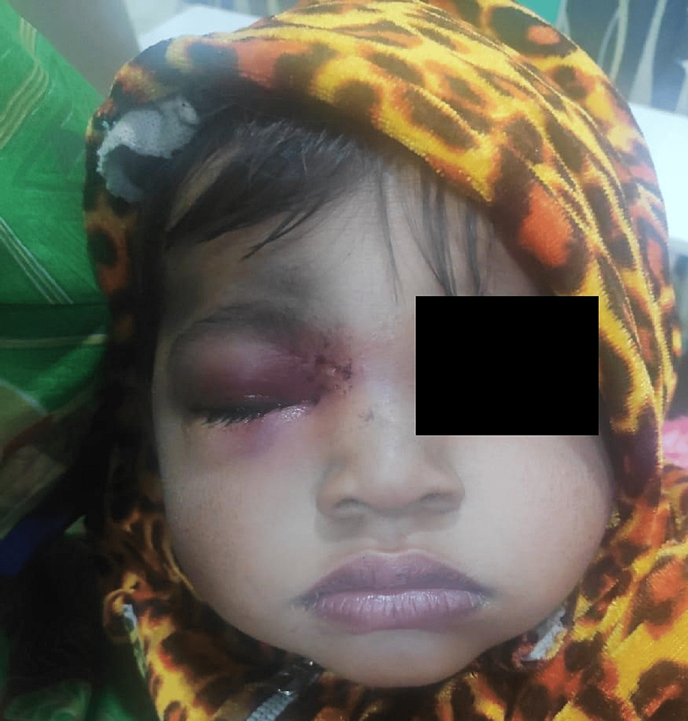 Showing-Opening-of-Foreign-Body-Tract-Between-Eye-and-Nasal-Bridge.