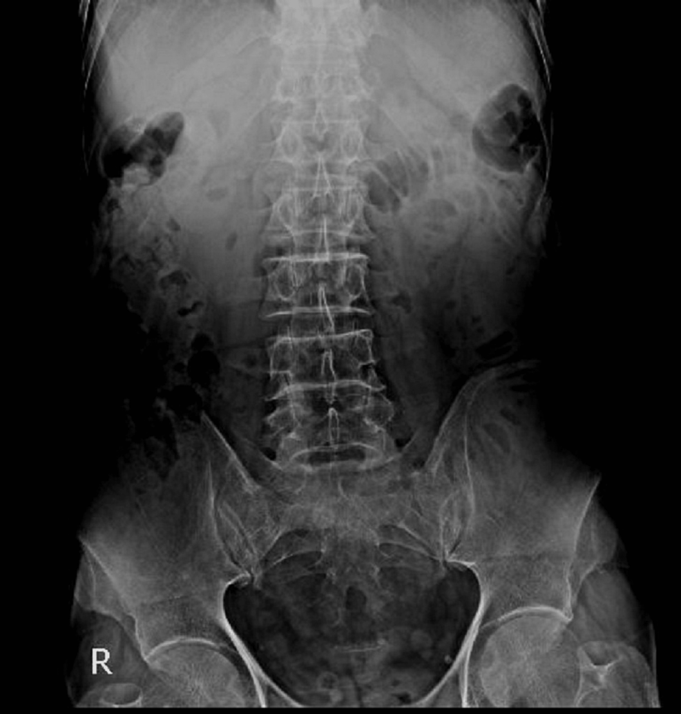 Upright-abdominal-X-ray-showing-mildly-dilated-small-bowel-loops Upright-abdominal-X-ray-showing-mildly-dilated-small-bowel-loops