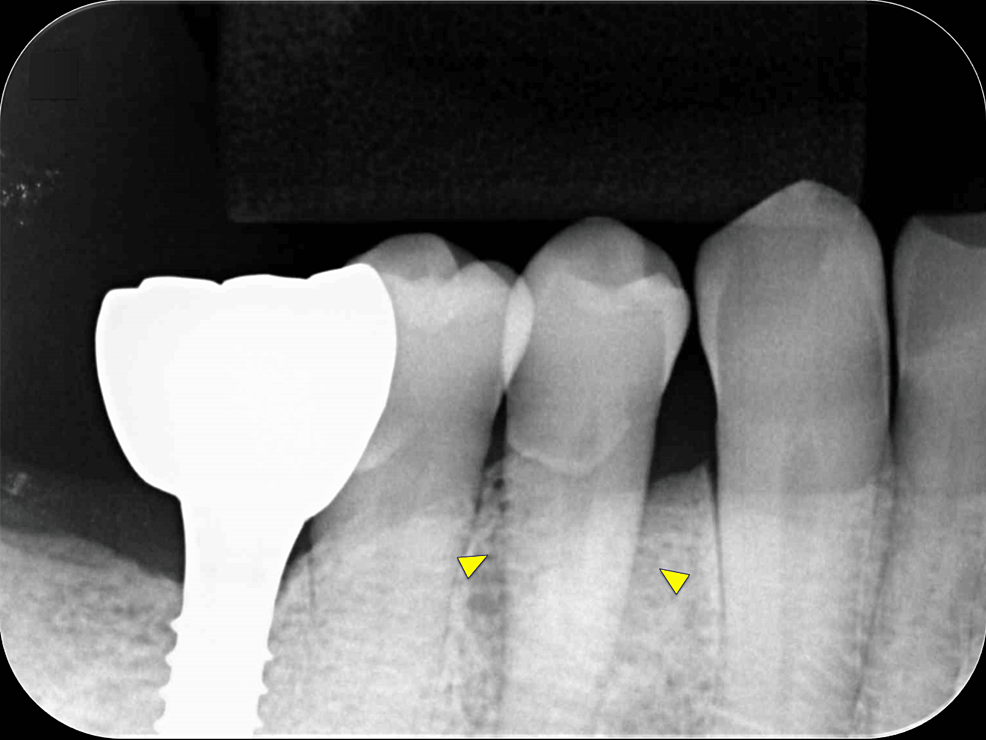 Postoperative-intraoral-radiographic-image.