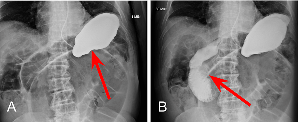 Small-Bowel-Series-at-One-Minute-and-30-Minutes