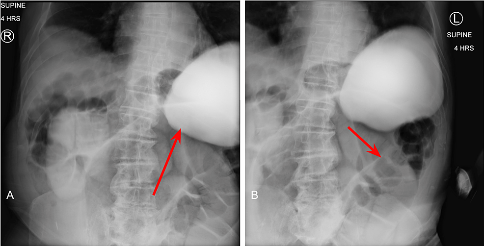 Small-Bowel-Series-at-Four-Hours