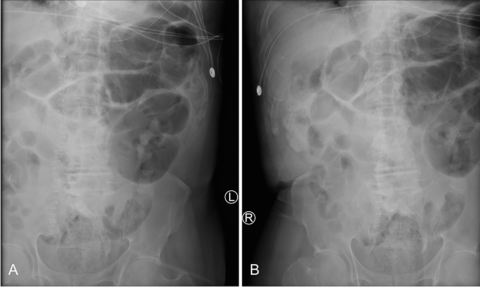 Kidney,-Ureter,-and-Bladde-(KUB)-Plain-Radiograph
