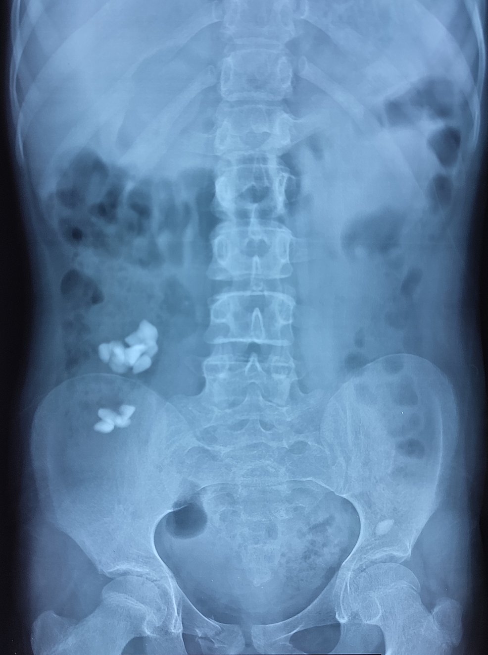 Plain-abdominal-X-ray-on-follow-up-visit-after-a-week.