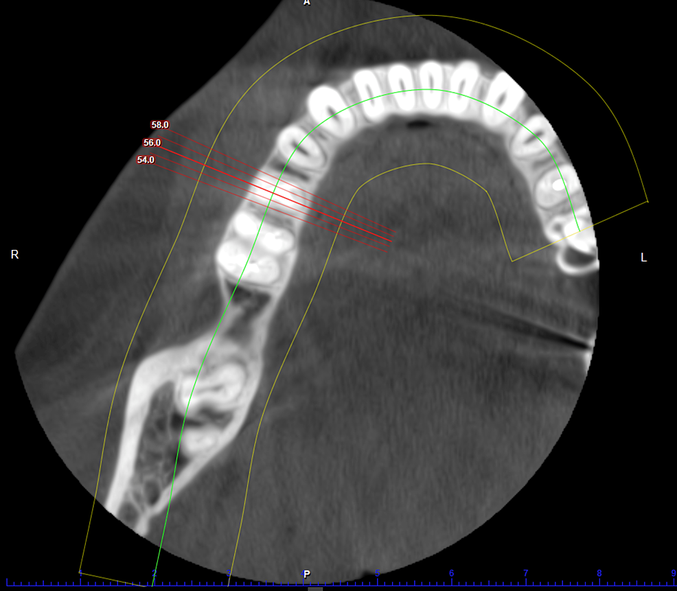 CBCT-depicting-axial-view