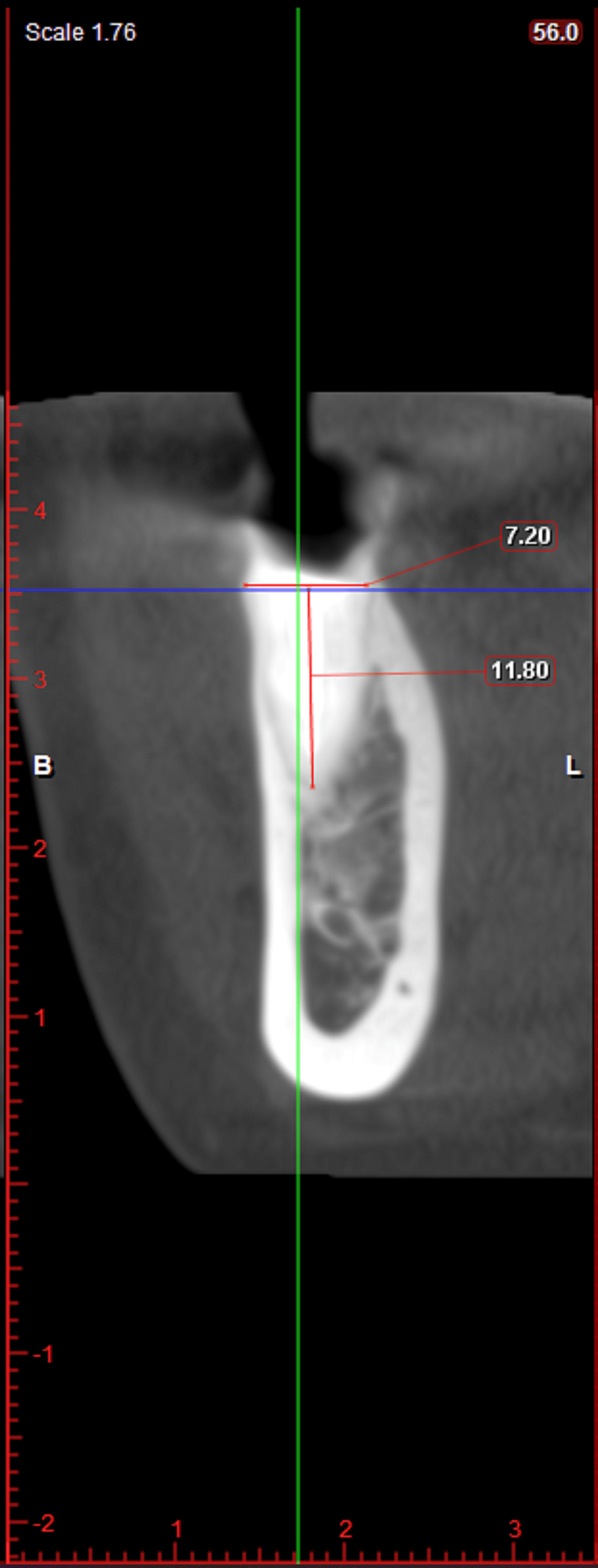 CBCT-showing-coronal-view
