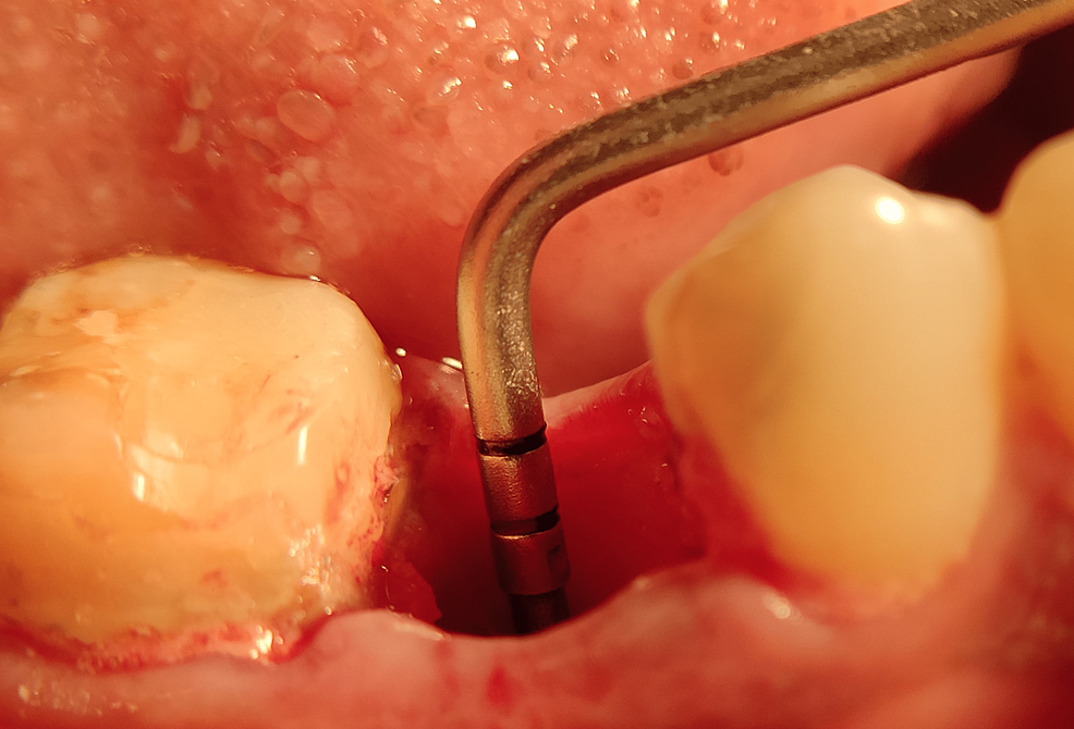 Post-extraction-view
