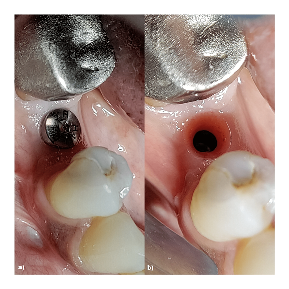 Depicting-second-stage-surgical-procedure