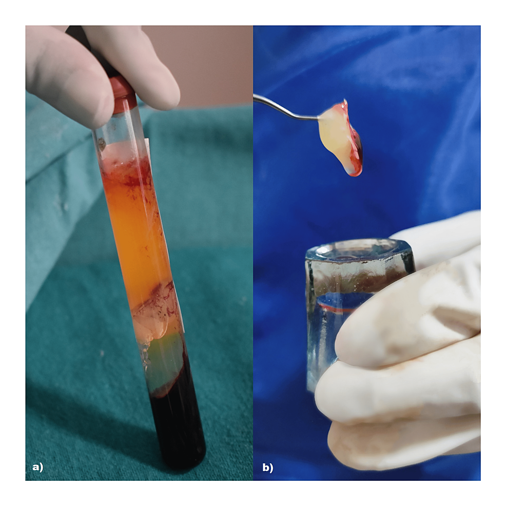 Obtained-platelet-rich-fibrin-matrix