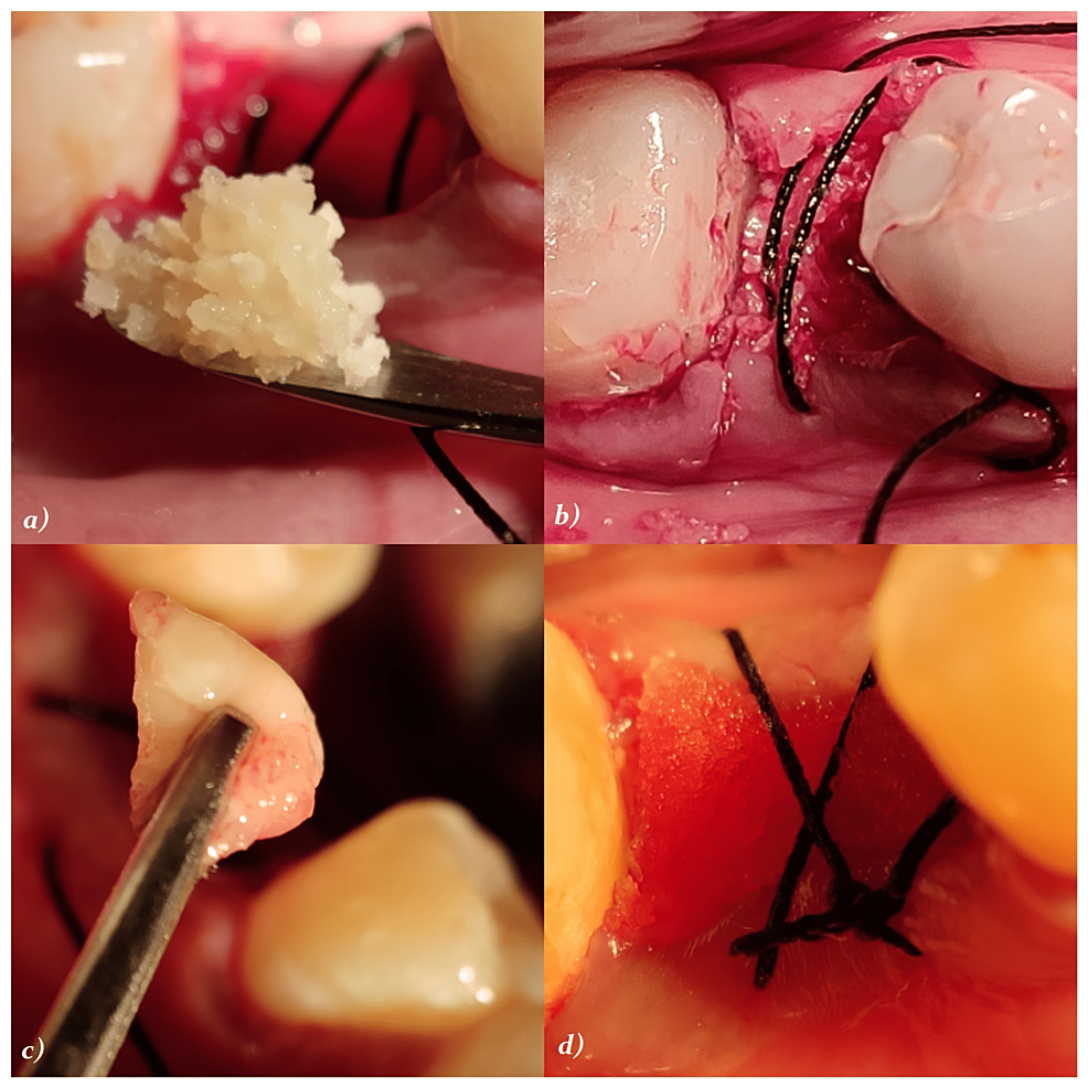Depicting-DFDBA-and-PRFM-placement-around-the-implant