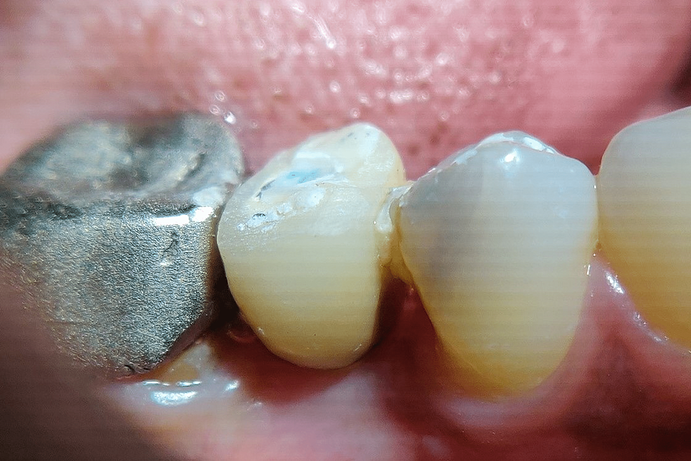 Depicting-definitive-prosthesis-after-3-months-