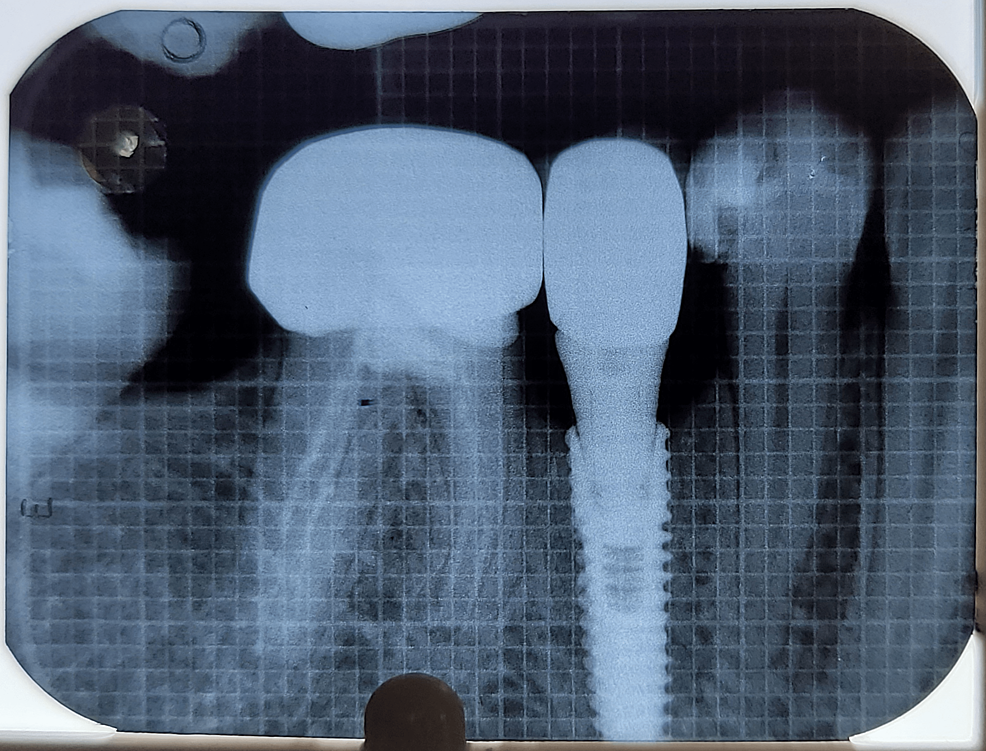Depicting-radiograph-obtained-at-6-months-postoperatively