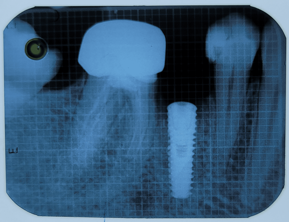 Depicting-baseline-radiograph-obtained-immediately-postoperatively