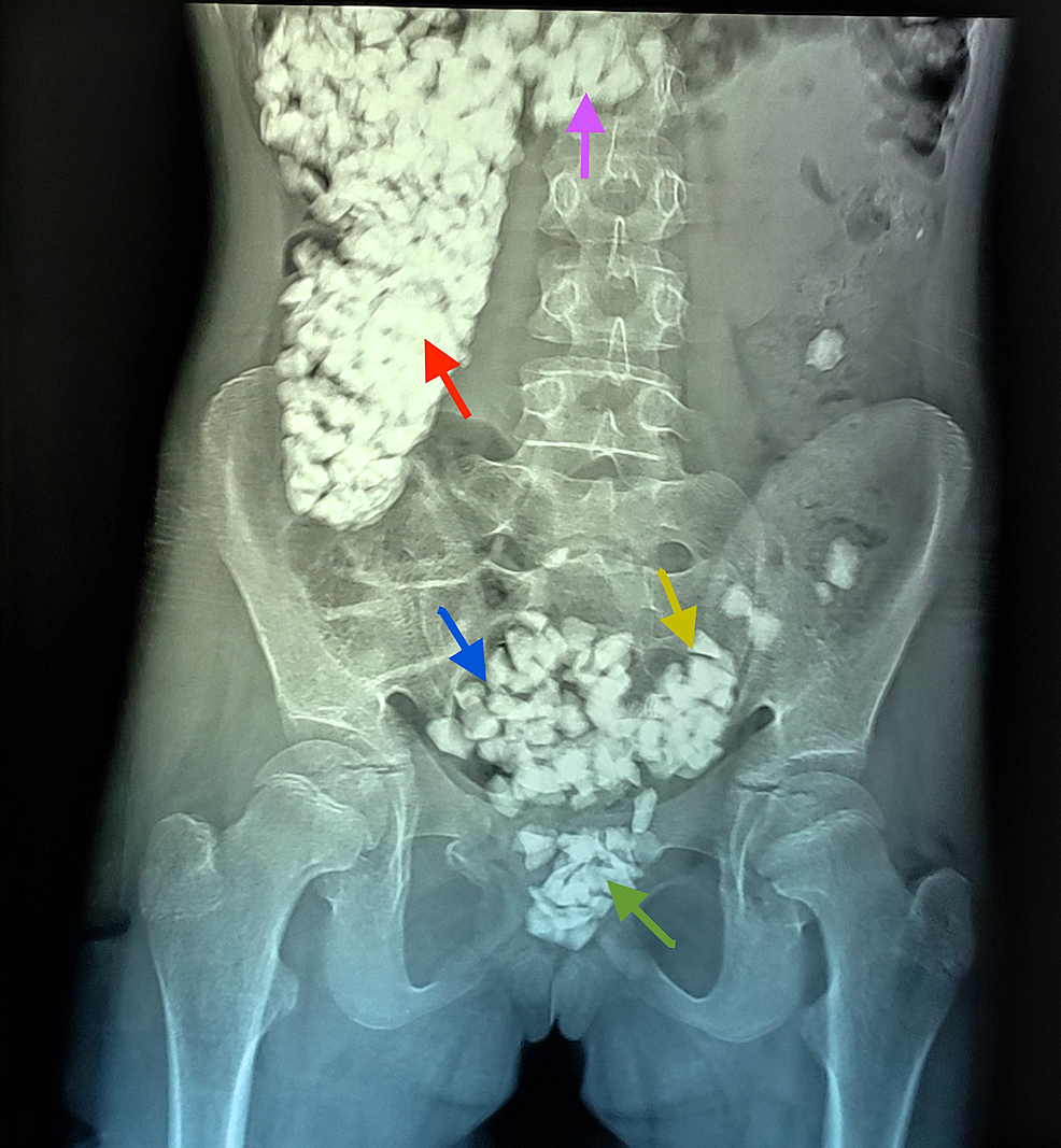 First-abdominal-X-ray-of-the-patient-taken-in-the-emergency-department.