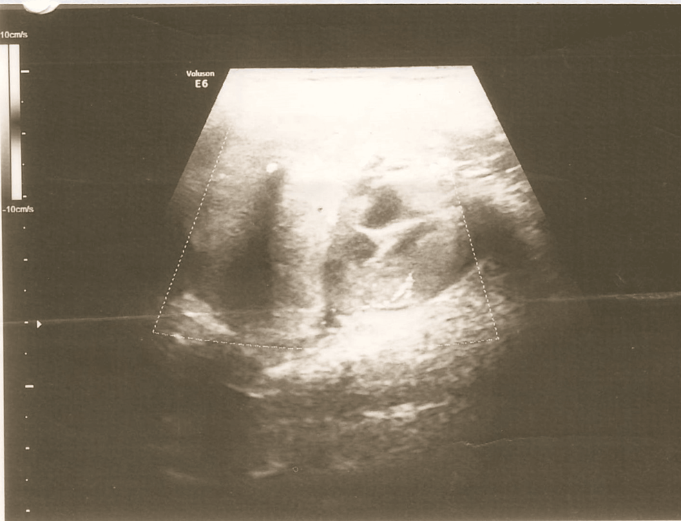 USG-of-the-right-submandibular-region
