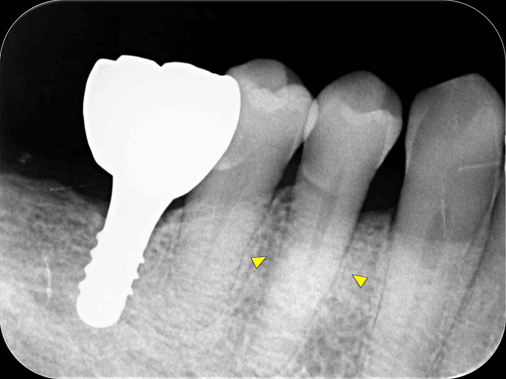 Preoperative-intraoral-radiographic-image.